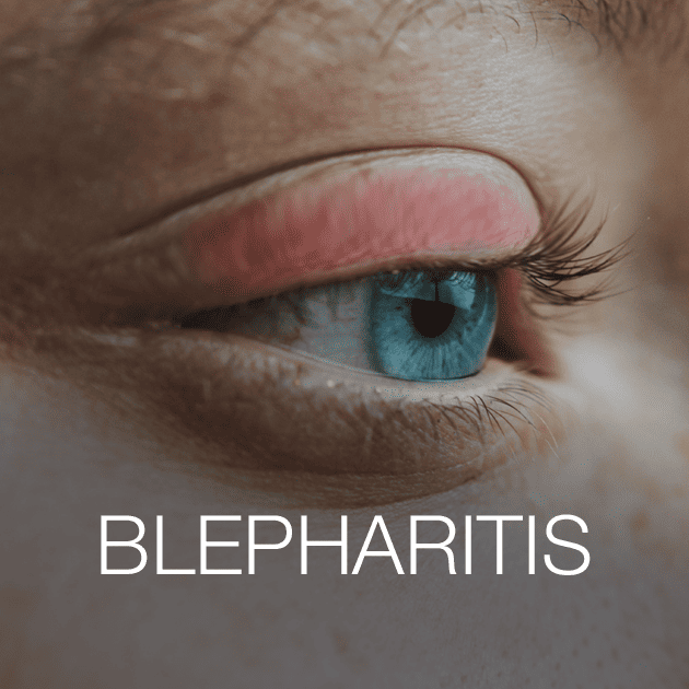 Blepharitis