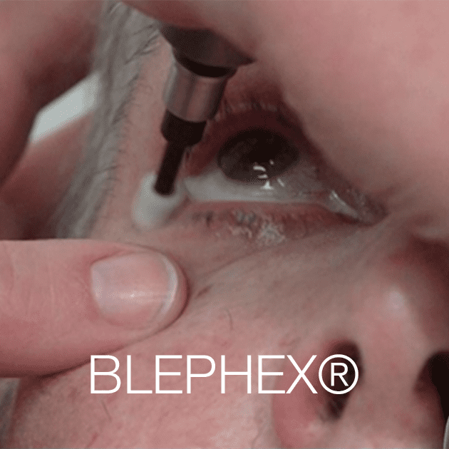 BlephEx®