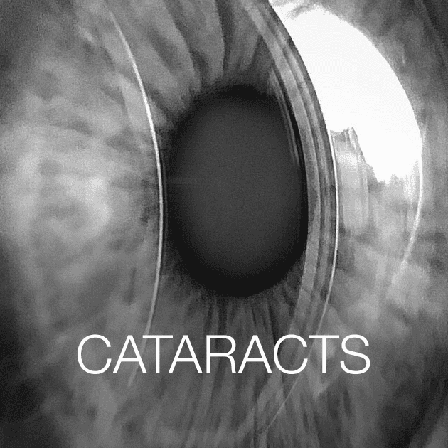 Cataracts