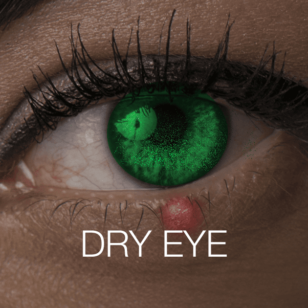 Dry Eye