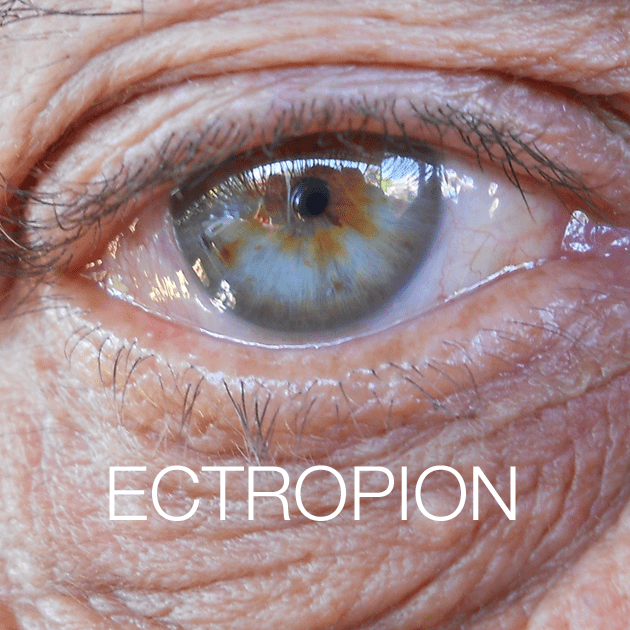 Ectropion & Entropion