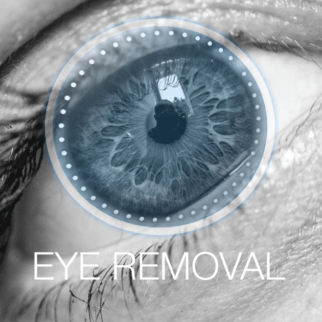Eye Removal