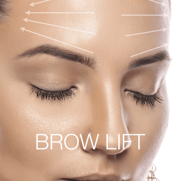 Brow Lift