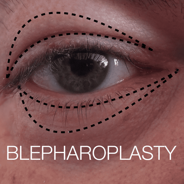 Blepharoplasty
