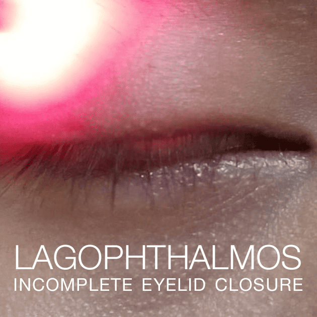 Lagophthalmos