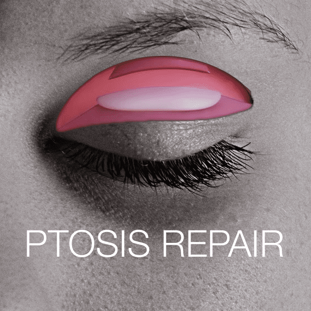 Ptosis Repair